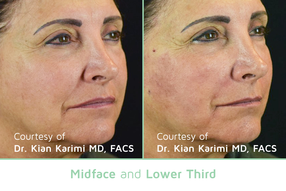 NovaThreads Midface & Lower third- Courtesy of Dr. Kian Karimi